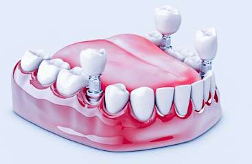 Dental Implant in kolkata